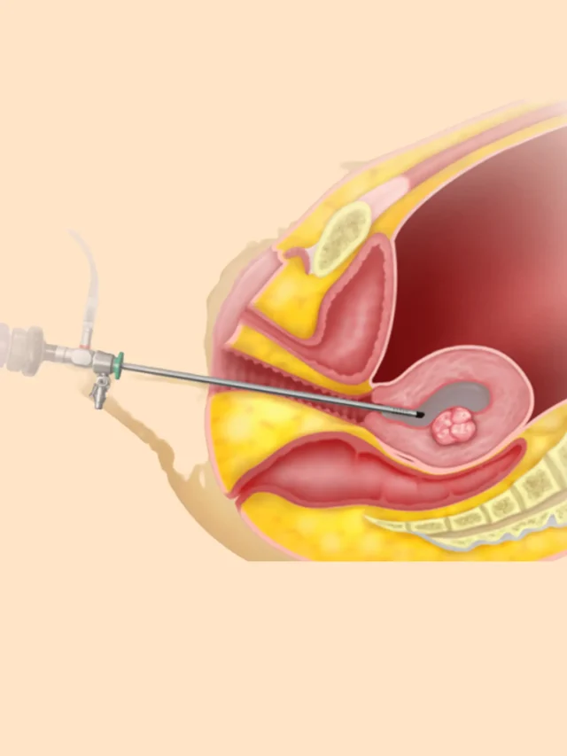 Hysteroscopy Treatment in Chennai