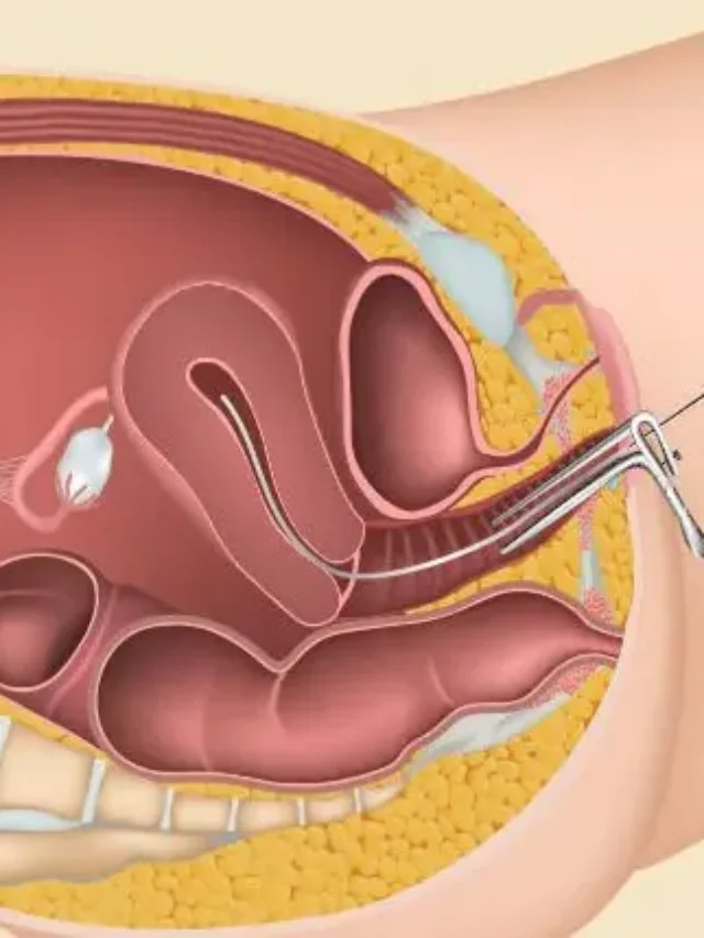 cropped-intrauterine-insemination.webp
